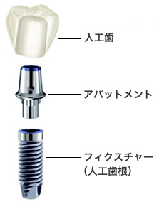 インプラントとは