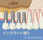 サイナスリフト解説画像4