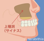 上顎洞サイナス画像
