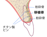 骨増生画像